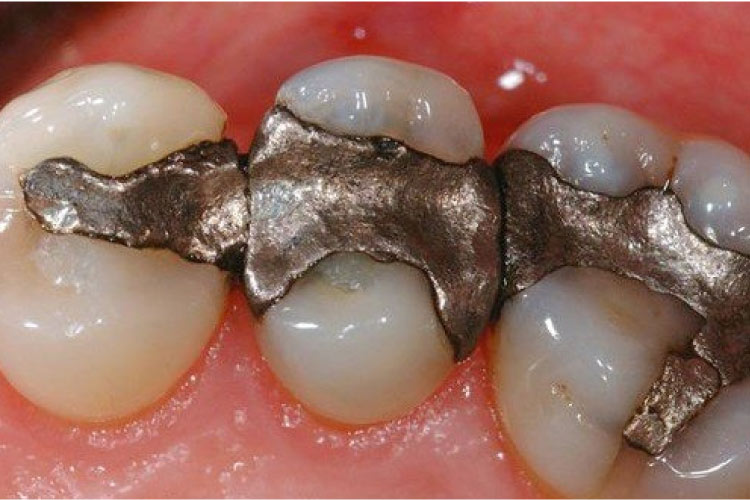 amalgam dental fillings at Smiles Dental
